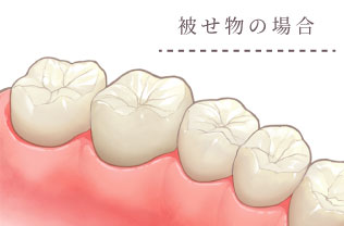 被せ物の場合