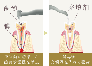 虫歯菌が感染した歯質や歯髄を除去/消毒後、充填剤を入れて密封