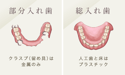 部分入れ歯：クラスプ（留め具は金属のみ）/総入れ歯：人工歯と床はプラスチック